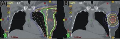 Low-Energy Intraoperative Radiation Therapy and Competing Risks of Local Control and Normal Tissue Toxicity